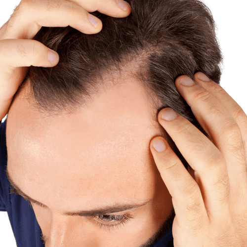 ¿Qué es la Alopecia? Todo lo que Necesitas Saber sobre la Pérdida de Cabello - Novalia Cosmetics